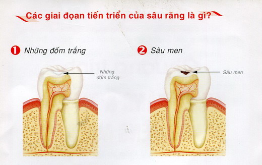 benh-sau-rang-01