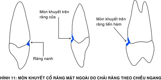 lam-gi-khi-chai-rang-sach-van-bi-sau-rang-01