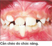 nguyen-nhan-can-cheo-rang-truoc-tre-em-02