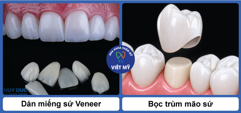 Răng sứ thẩm mỹ 3 phan-biet-boc-rang-su-va-mat-dan-su-veneer
