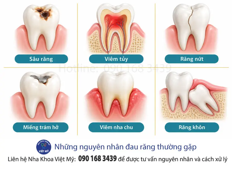 Đau răng là do đâu? Nguyên nhân và cách xử lý an toàn 3 hinh-anh-minh-hoa-nguyen-nhan-dau-rang