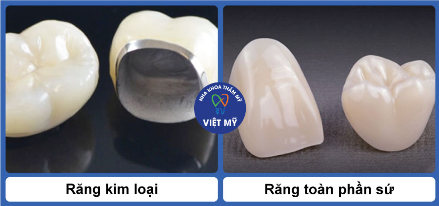 Răng sứ thẩm mỹ 2 https://nhakhoathammyvietmy.com/wp-content/uploads/2026/09/rang-kim-loai-va-rang-toan-phan-su.jpg