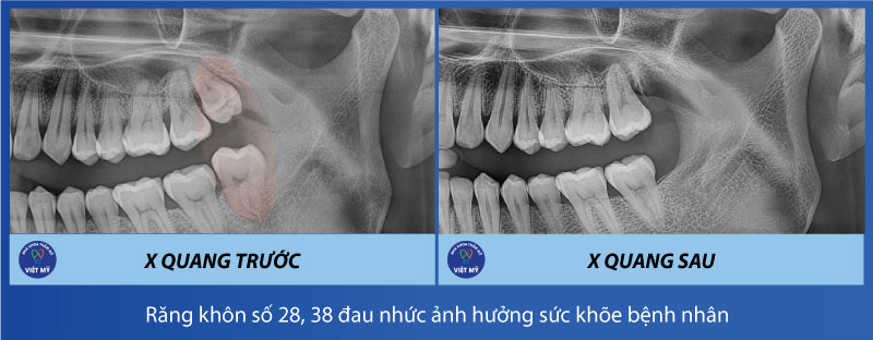 chup-x-quang-tai-nha-khoa-viet-my-mien-phi